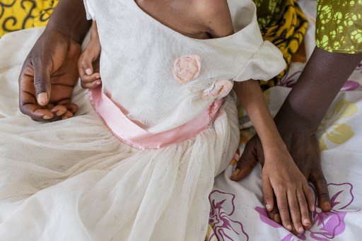 DRC malnutrition